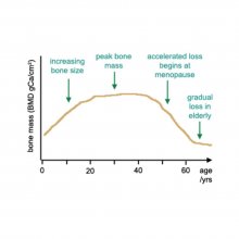 Osteoporosis – shock diagnosis
